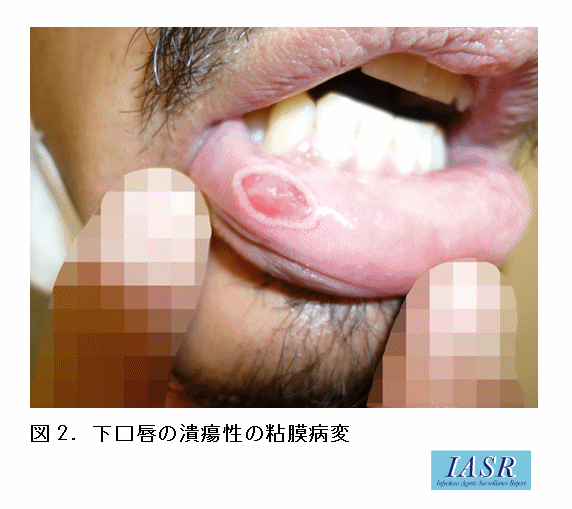 梅毒画像_第1期_腔咽頭病変2
